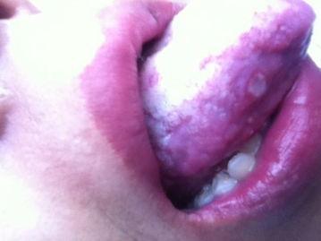 吃瓜嘴唇起泡舌头痛,吃瓜解暑却引发口腔不适，揭秘嘴唇起泡舌头痛的成因及应对策略